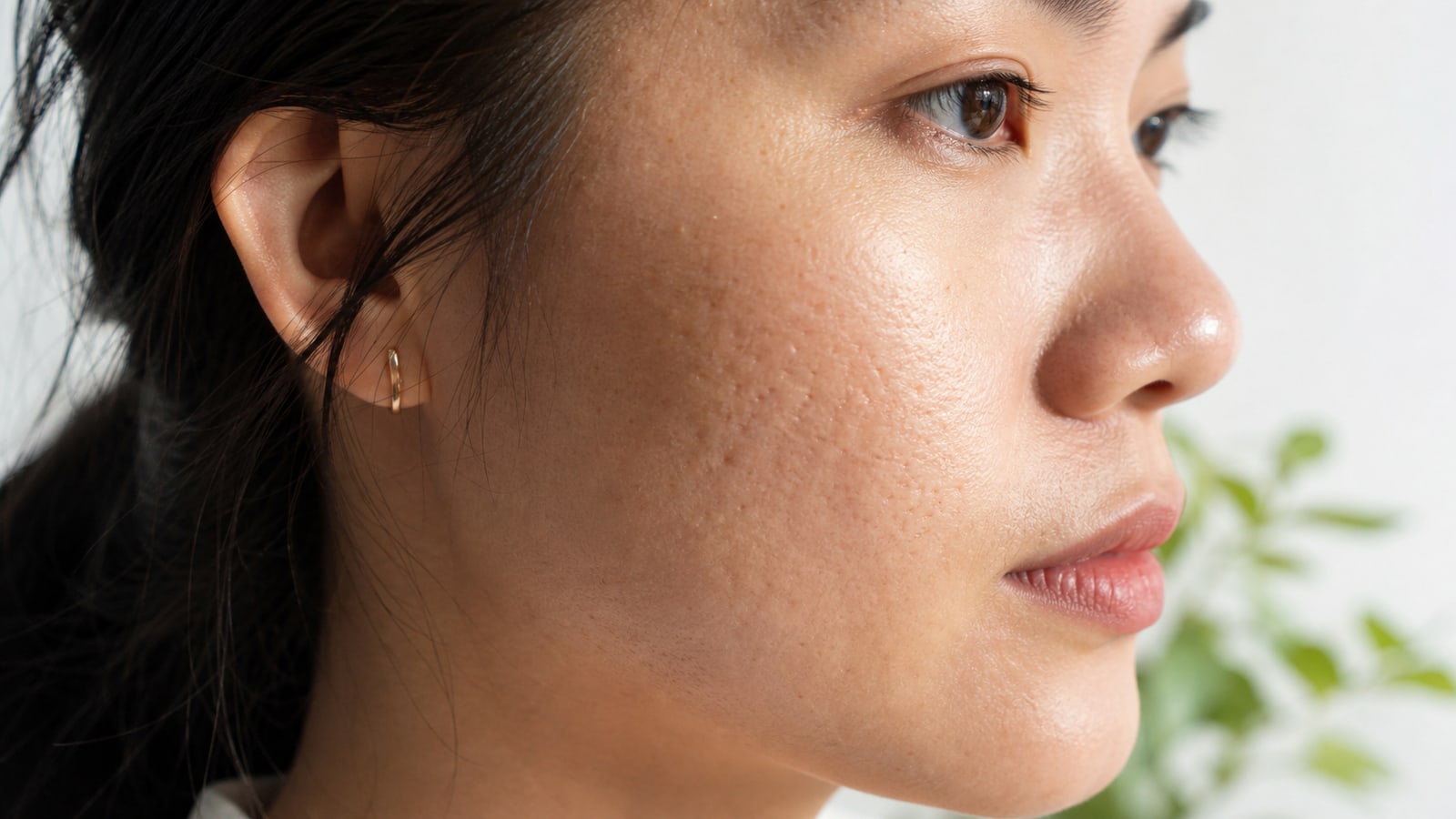 Phân biệt sẹo rỗ và lỗ chân lông to dưới ánh sáng xiên