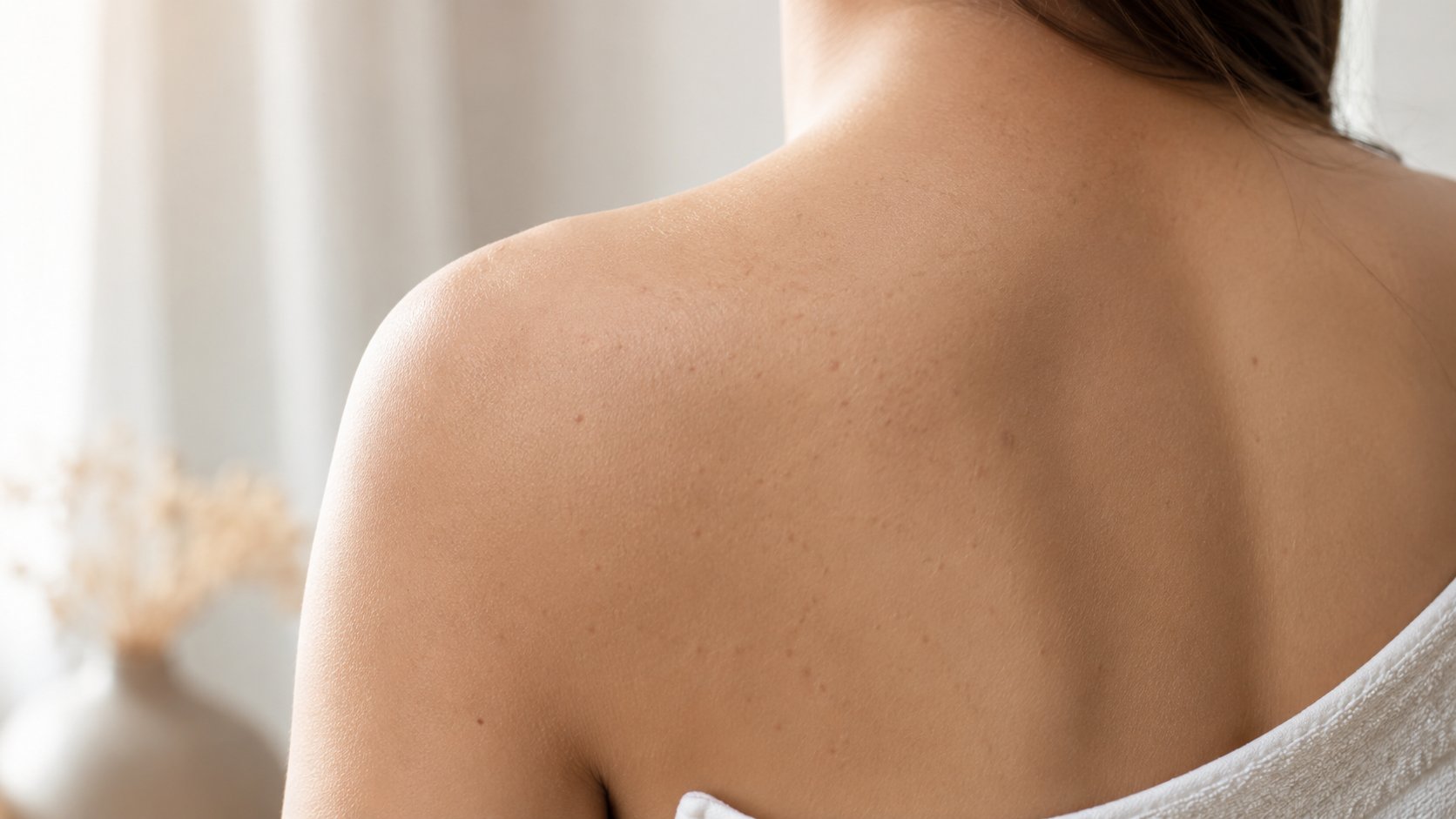 Sẹo Rỗ Ở Lưng và Ngực: Nguyên Nhân và Cách Điều Trị Khác Với Mặt